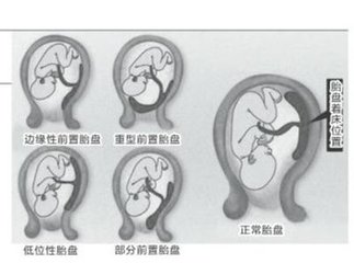 前置胎盘最典型的症状表现