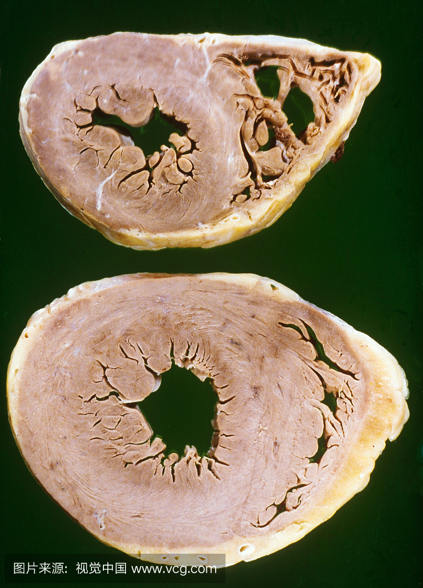 对心脏瓣膜疾病的心肌肥大(过度生长)。正常心