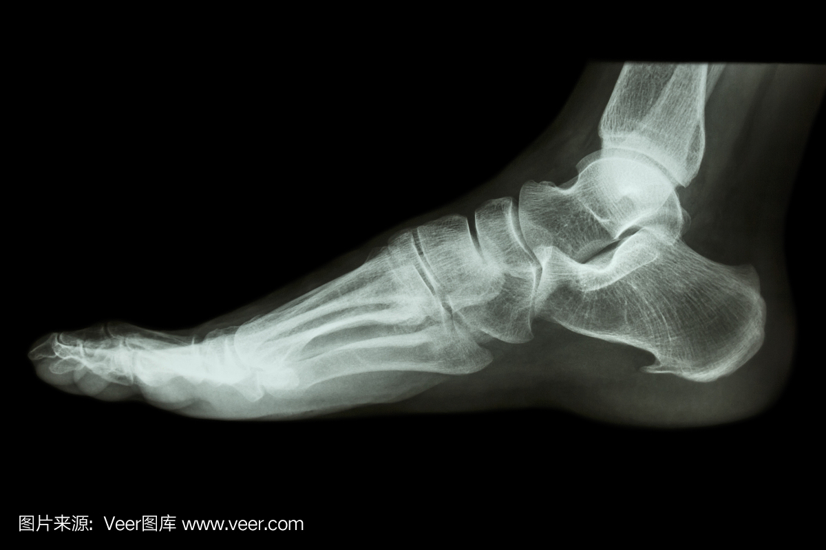 X射线正常人的脚侧