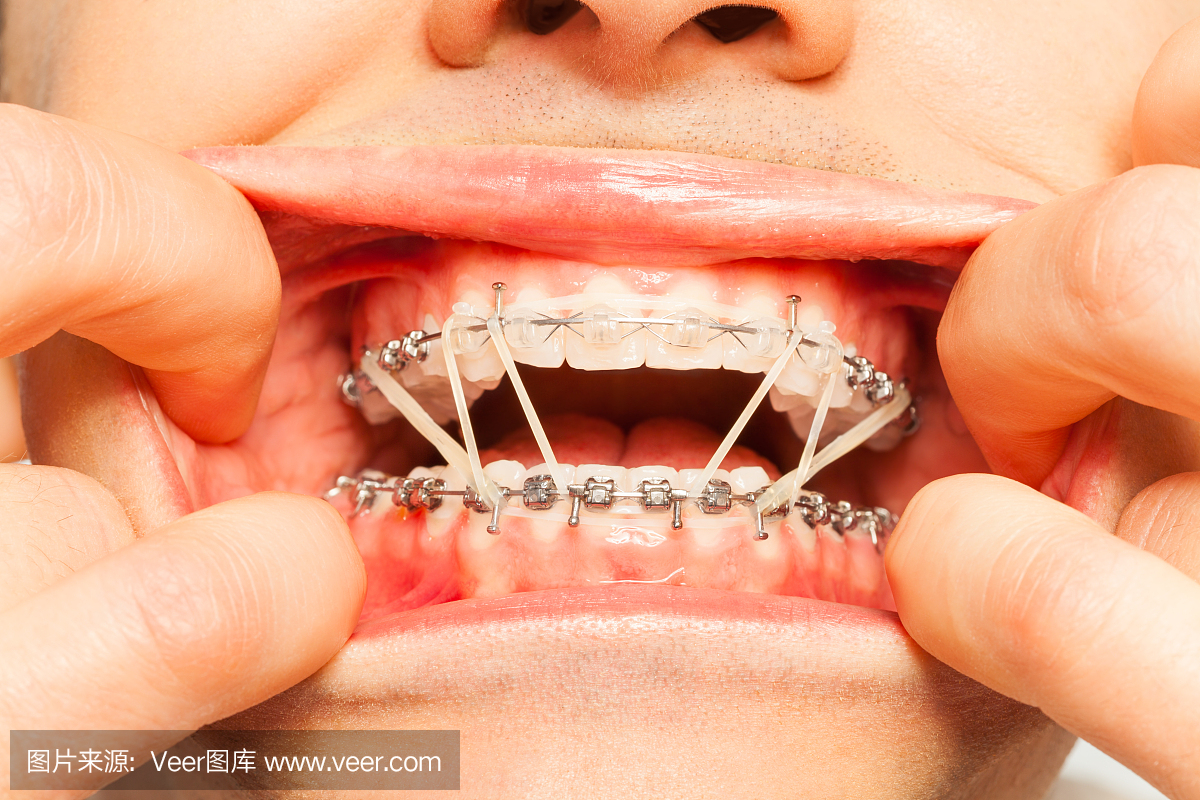 隐形矫治,隐形牙套,隐形矫正,隐适美