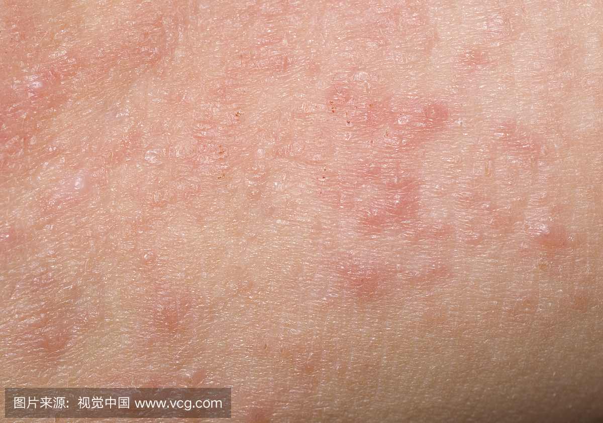 红色皮疹与小孩碰撞,疤痕和丘疹