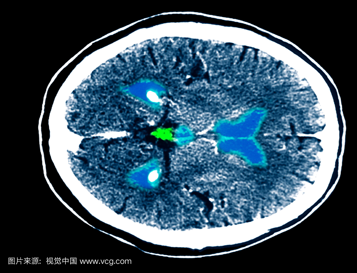 正常脑CT扫描。