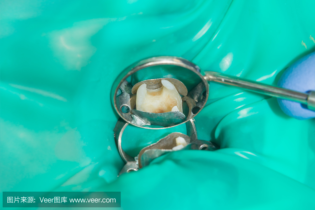牙齿特写的根管治疗。清洁牙齿的根部及其填充