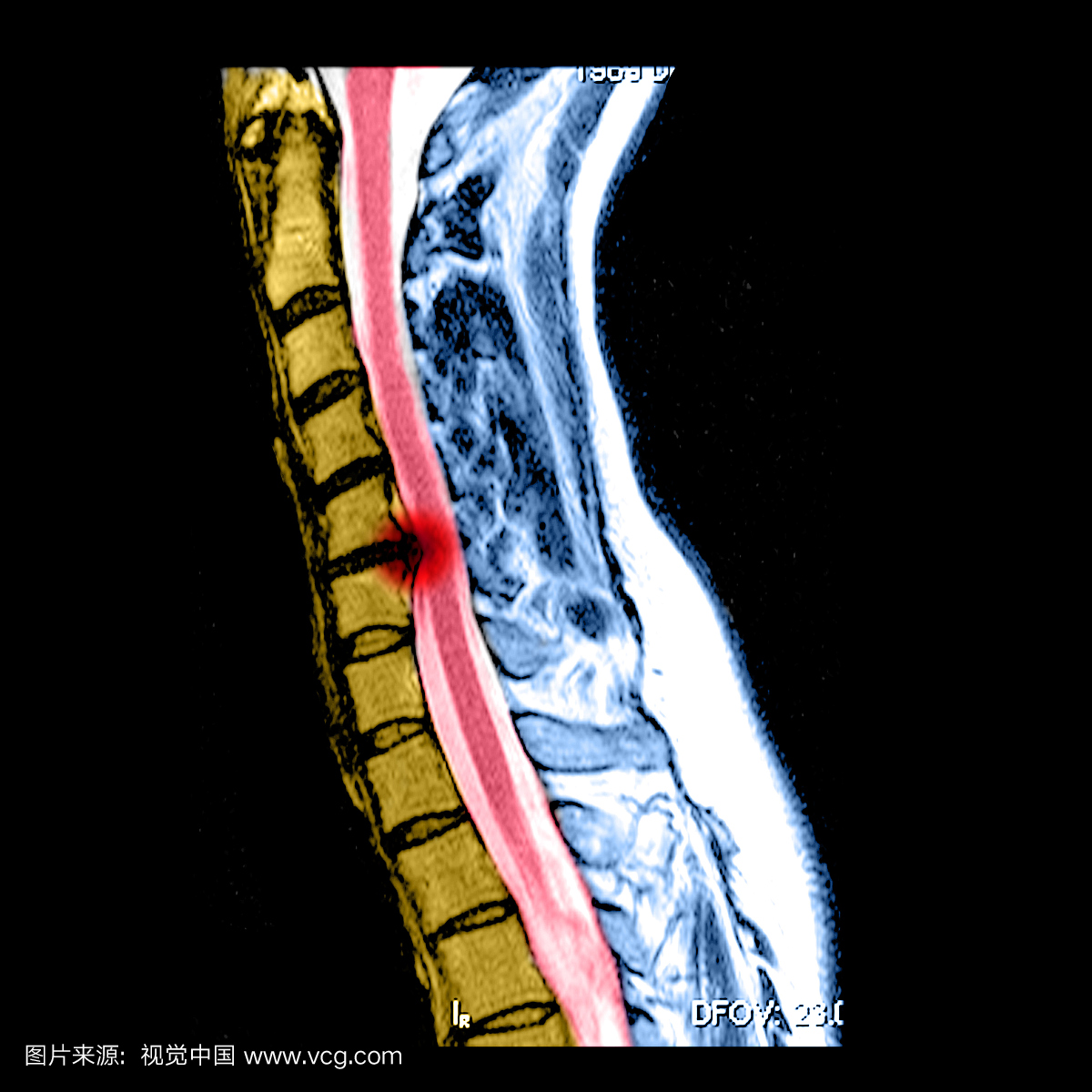 颈部(颈椎)的侧面(从侧面)MRI图像很好地显示了