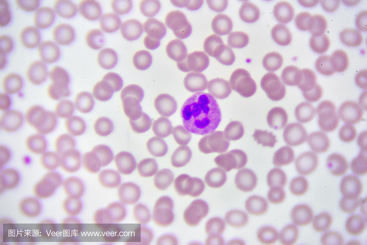 血涂片中的中性粒细胞