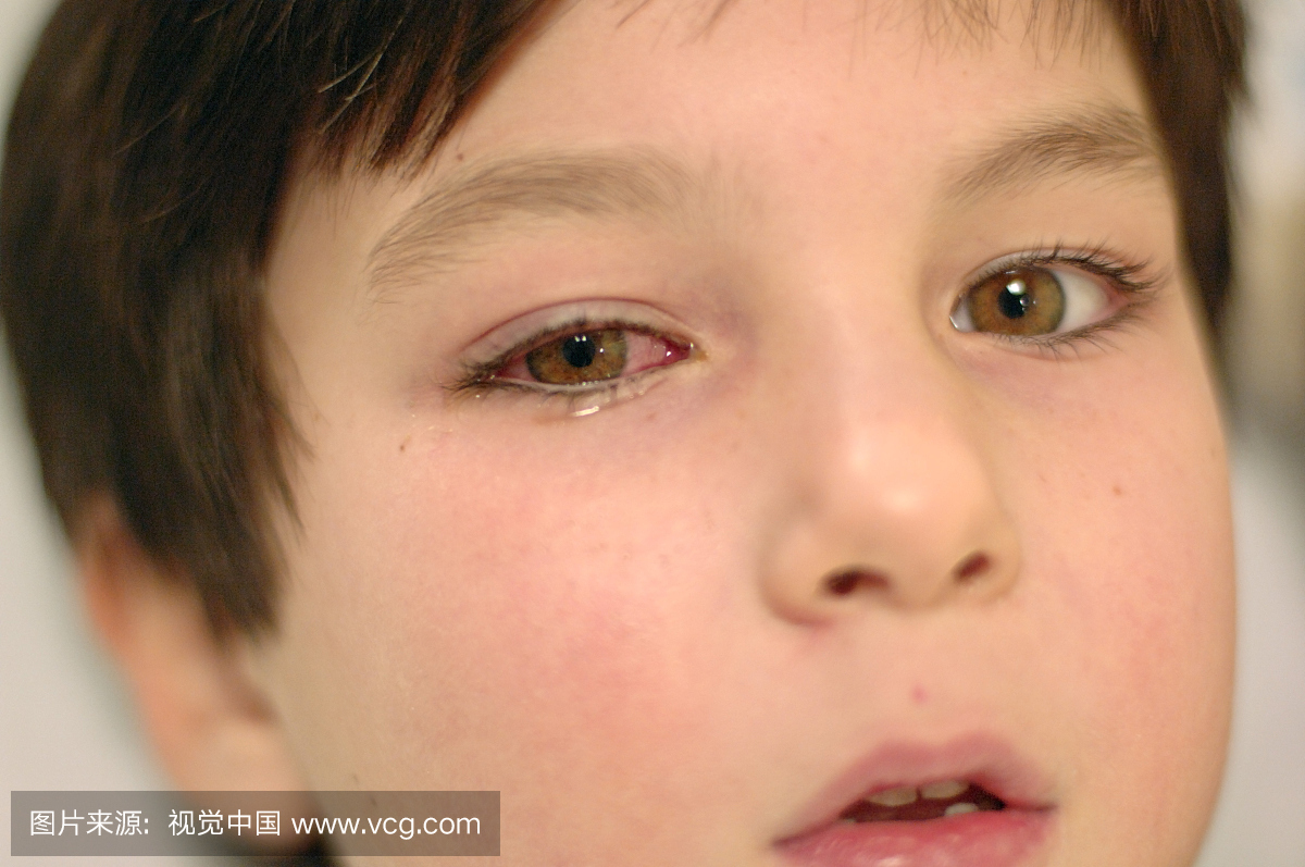 六岁的男孩病毒性结膜炎。