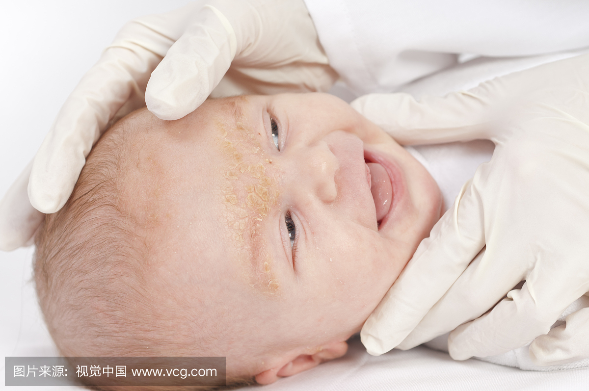 医生检查宝宝与脂溢性皮炎