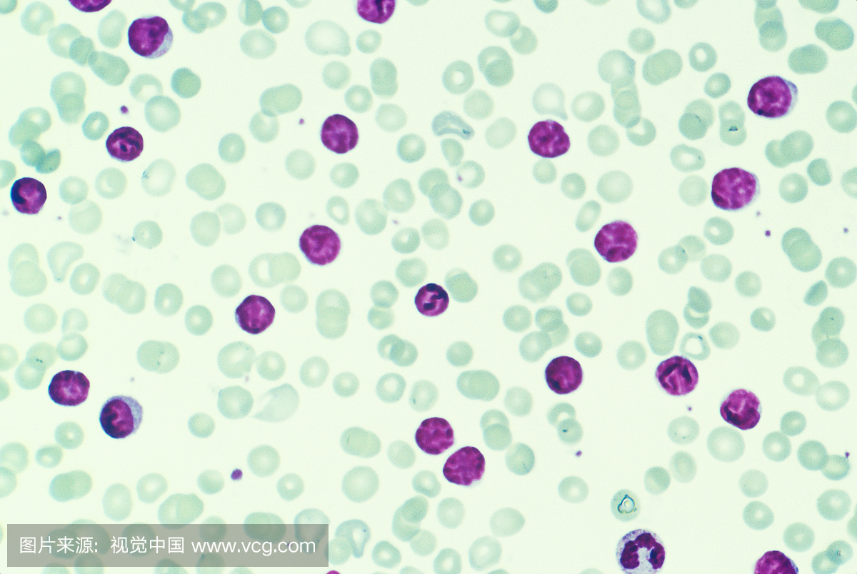 血液涂片显示慢性淋巴细胞性白血病(CLL)。 C