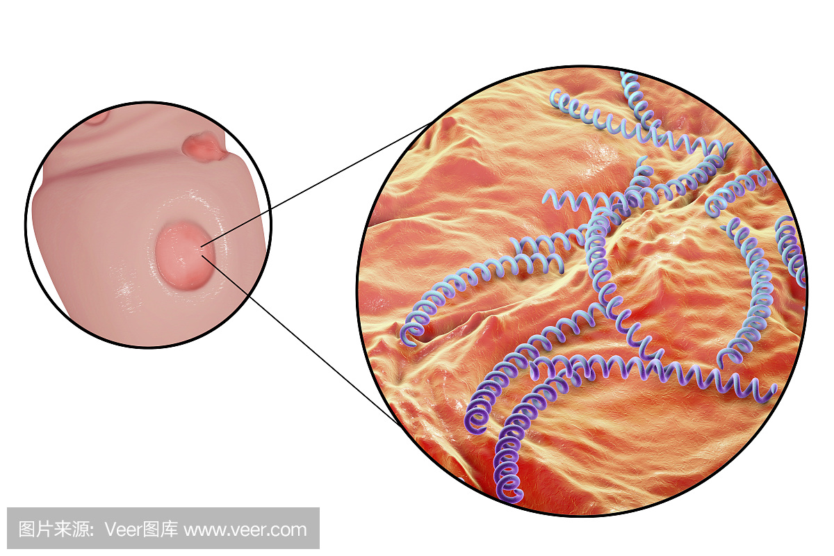 梅毒溃疡和细菌梅毒螺旋体
