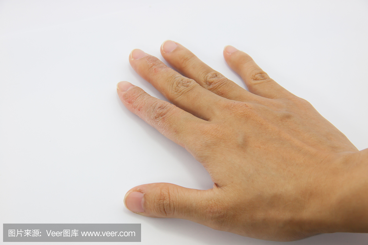 手指上寻常疣液氮冷冻治疗记录 - 知乎