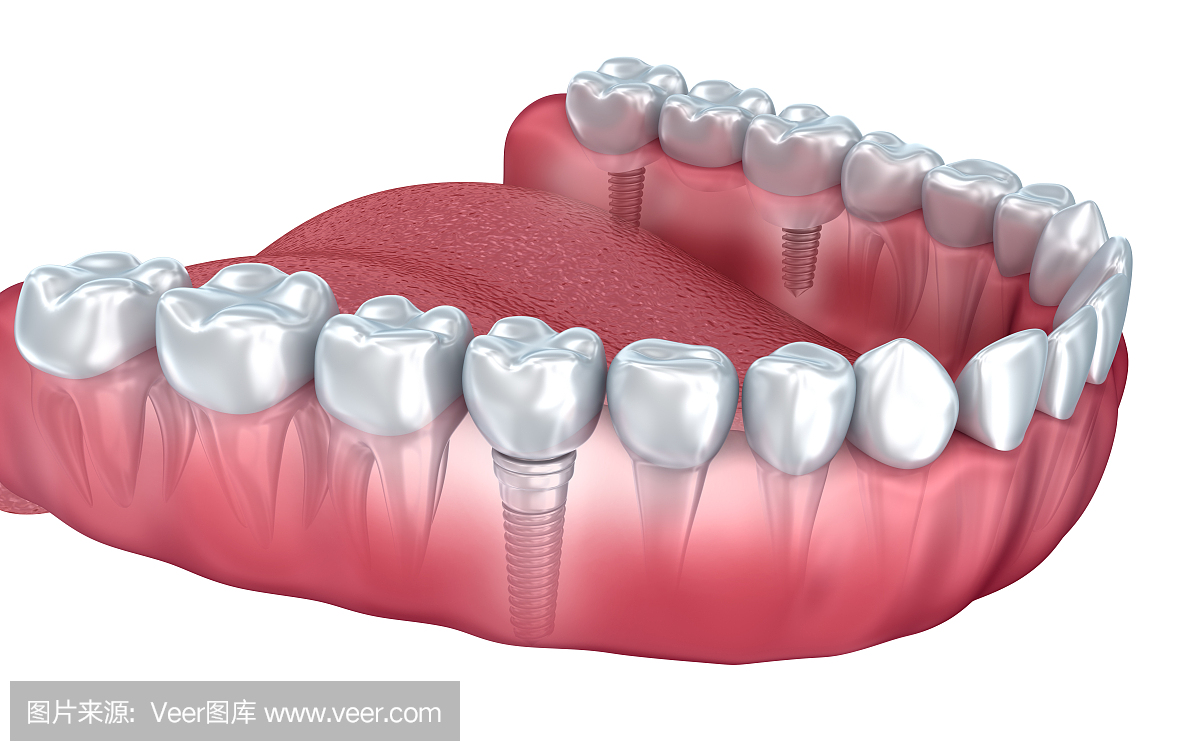 下牙和牙科植入物透明呈现在白色隔离