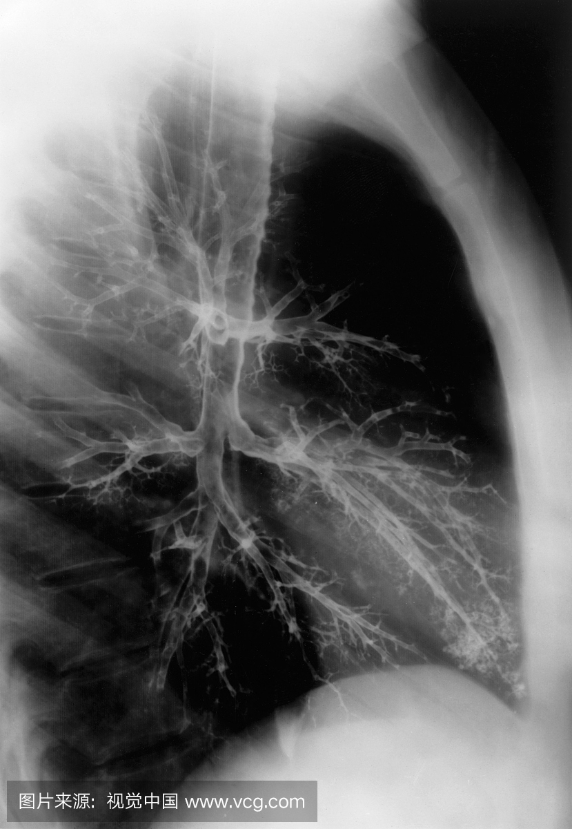 健康肺支气管图。支气管造影通过将无线电不透