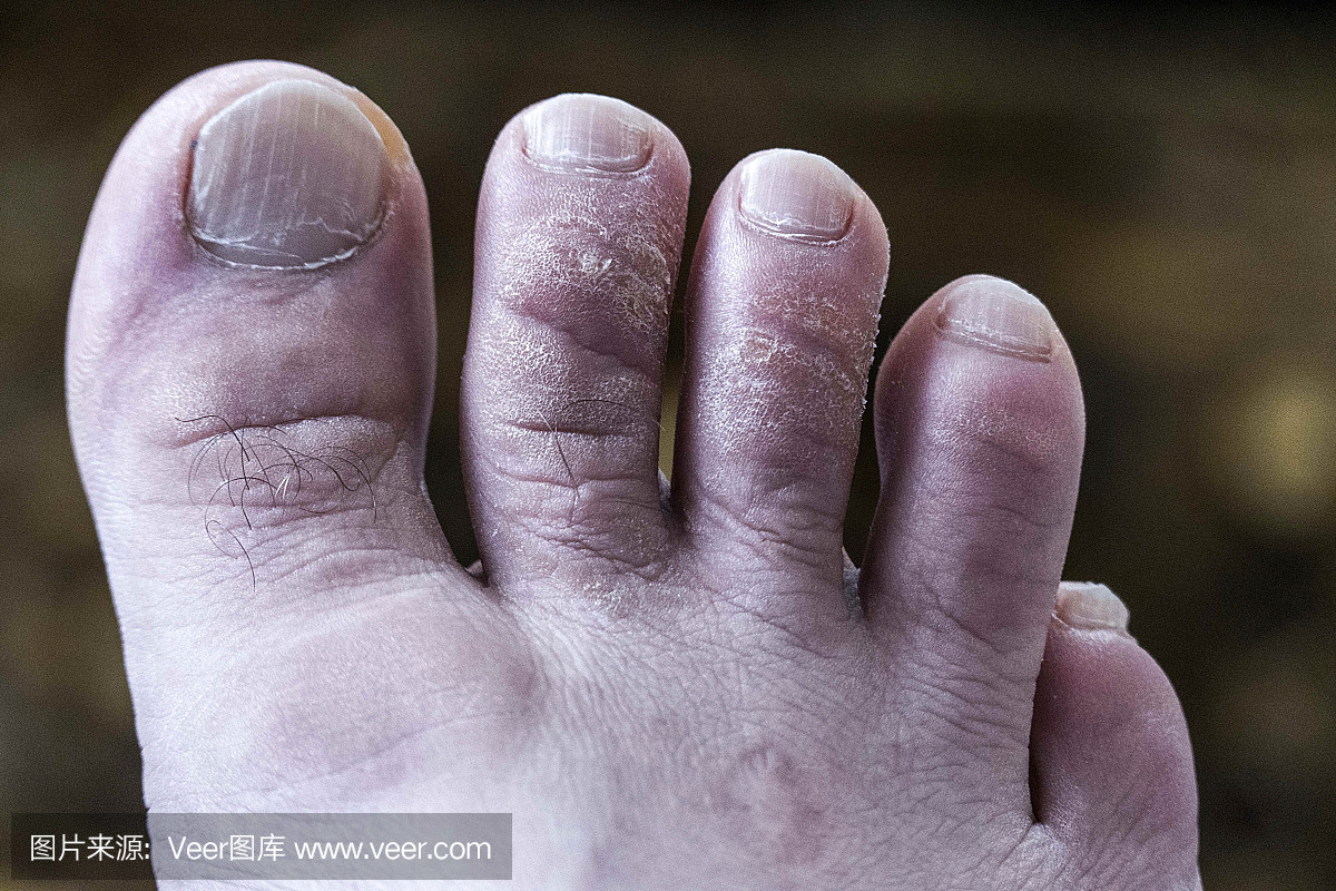 足部健康,脚趾上发痒蘑菇,足部真菌