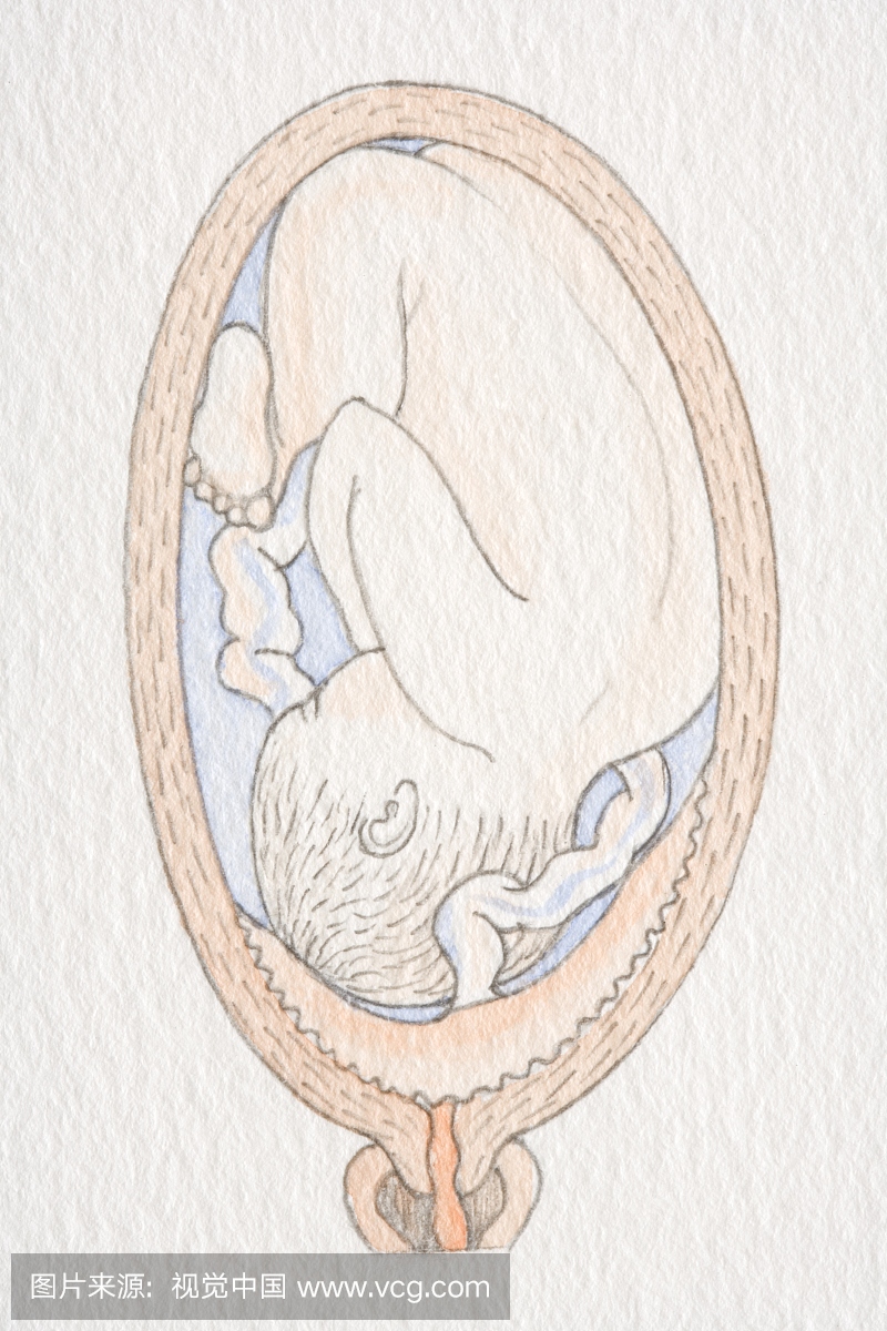倒置的胎儿在肿胀的子宫内与胎盘覆盖子宫颈开