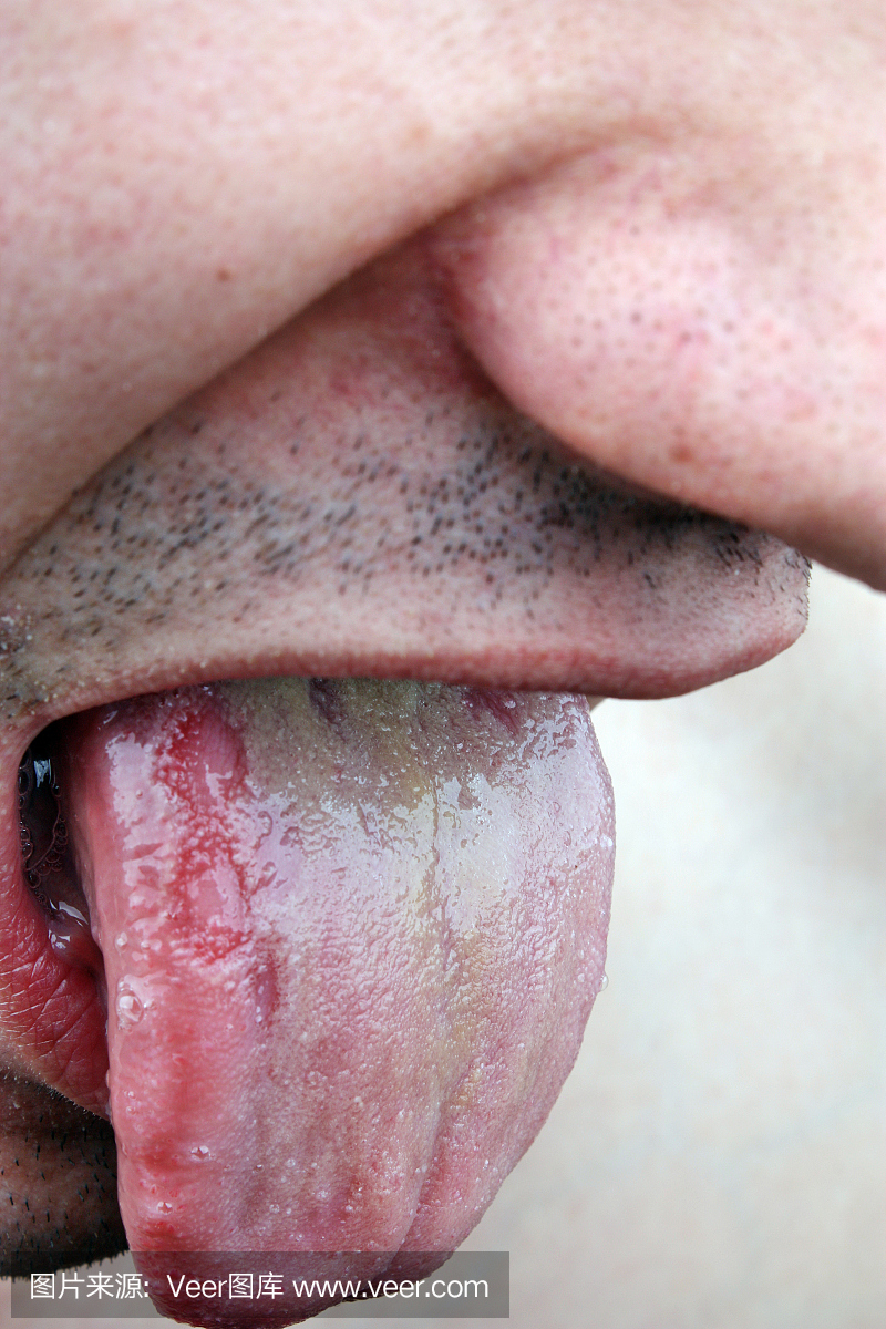 细菌性感染病舌