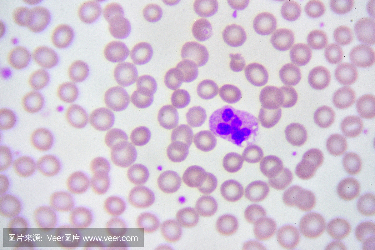 血涂片中的中性粒细胞