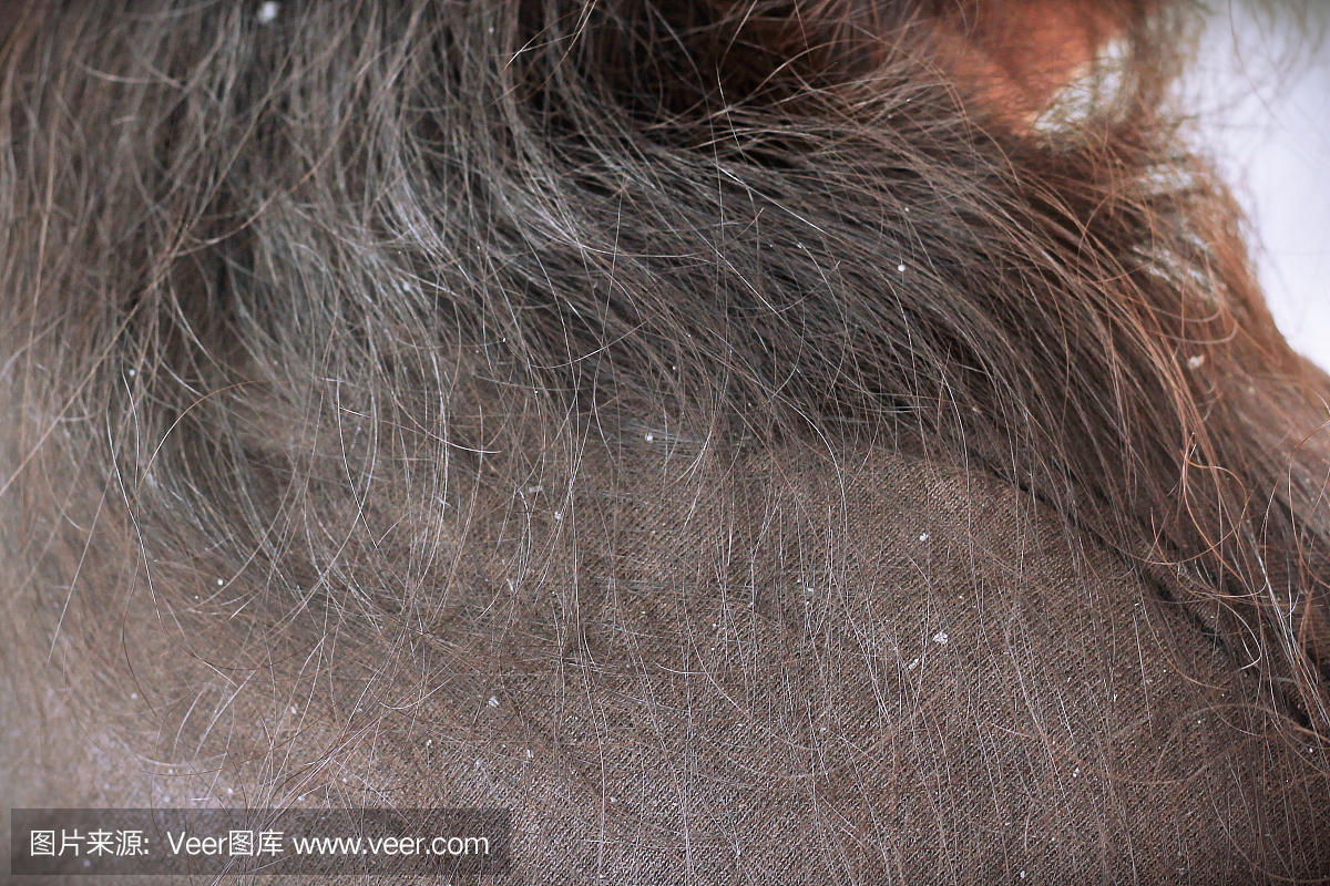 妇女在头发和肩膀上有头皮屑