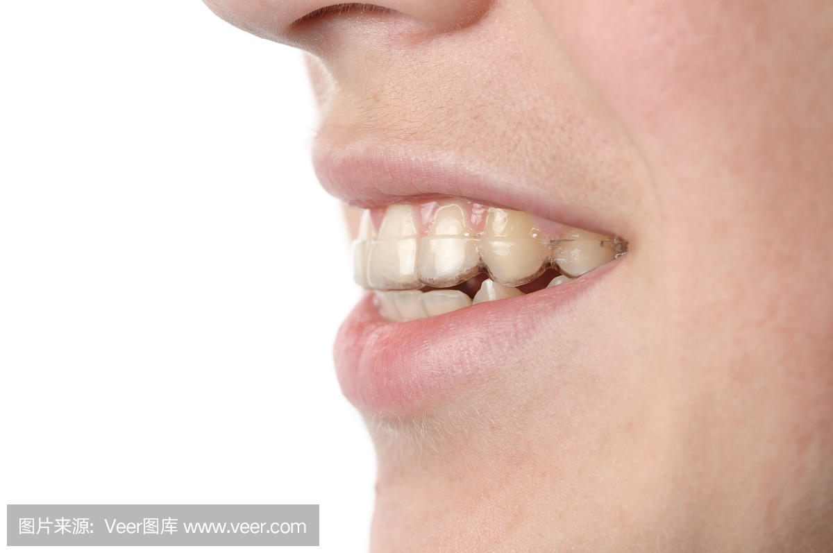 带塑料牙齿保持器的嘴侧视图