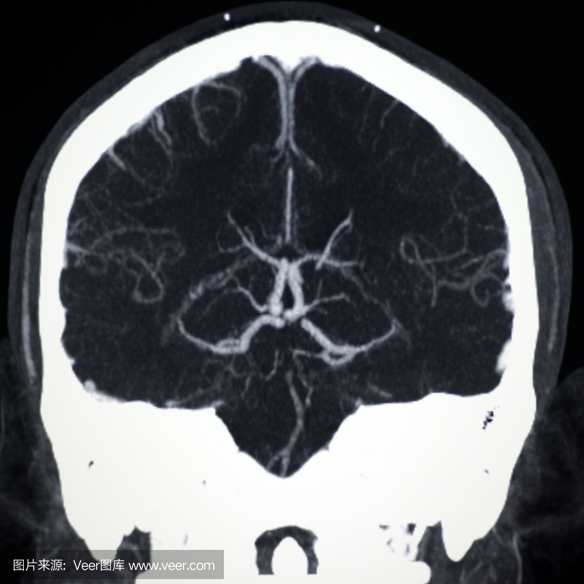 脑动脉显示头部CT图像