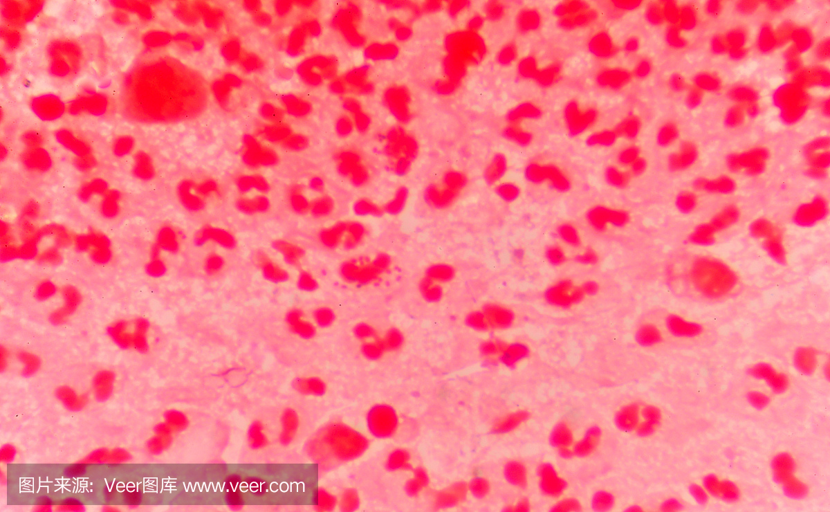 中度红细胞与革兰氏阴性双球菌