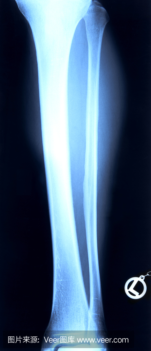 男性胫骨和腓骨
