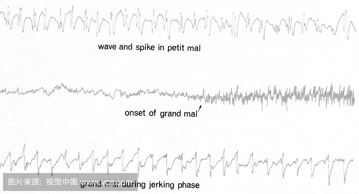 癫痫发作由EEG迹线显着表现。大脑中最大和