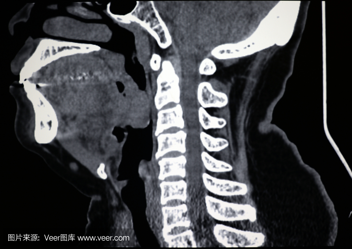 人类颈椎CT图像(软组织窗)