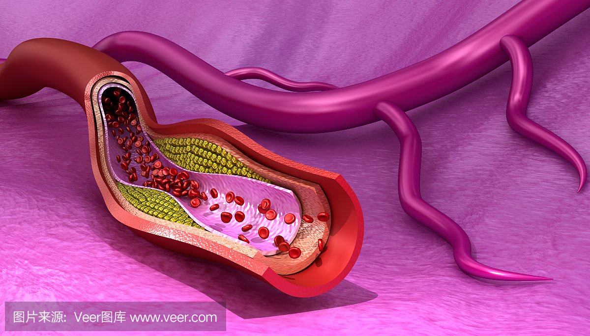 血管中的胆固醇斑块,医学上准确的3D插图