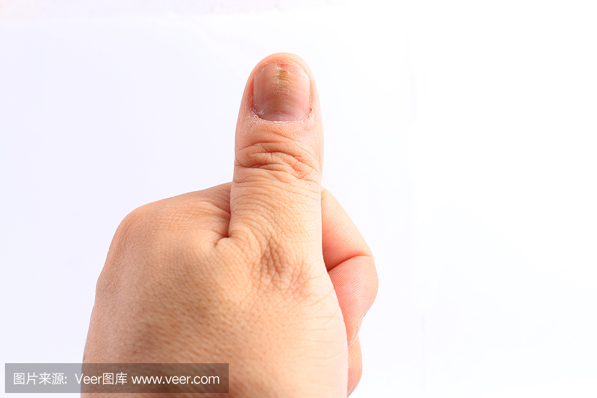 指甲上的真菌感染手,手指与甲真菌病,指甲上的