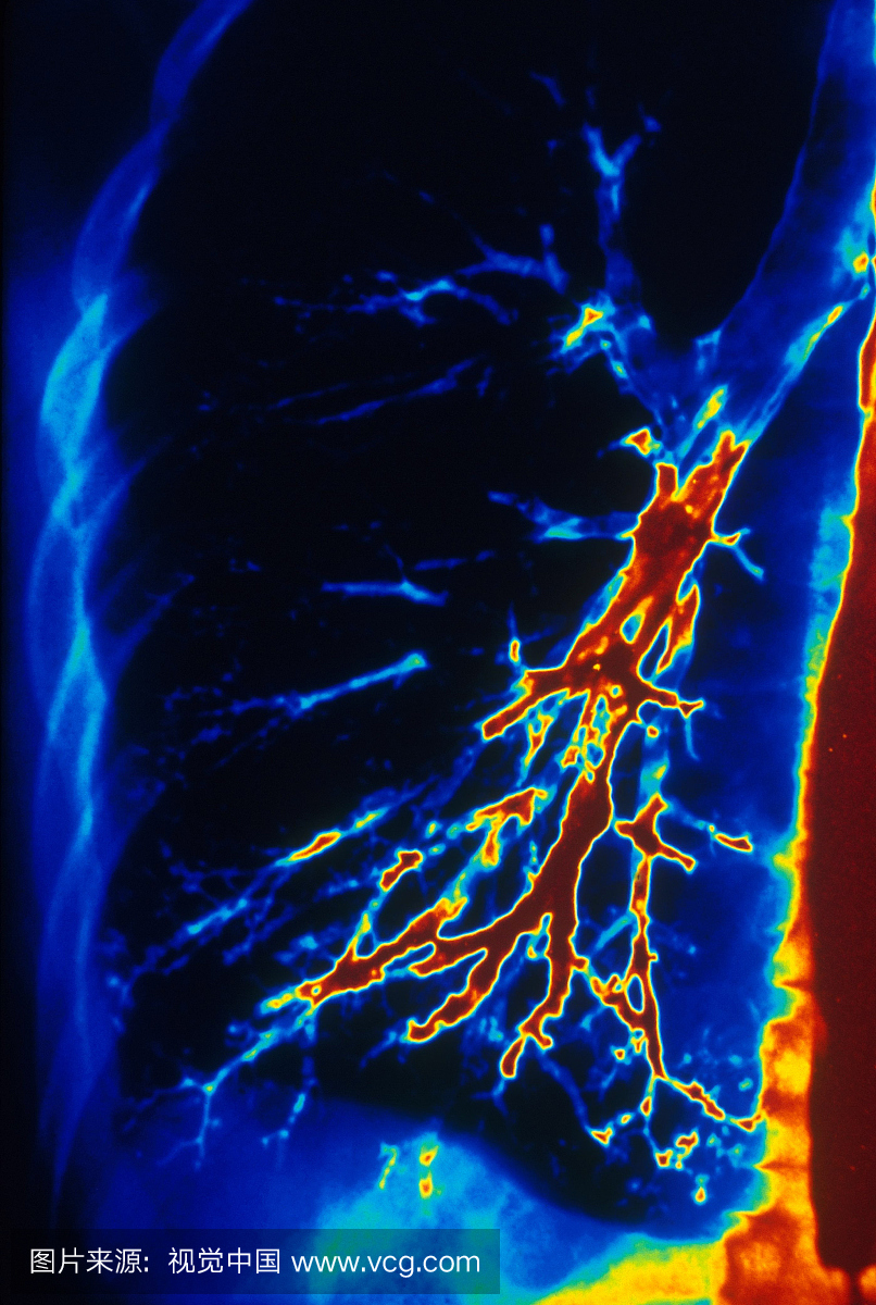 人肺支气管的彩色支气管镜(X光片)。支气管造