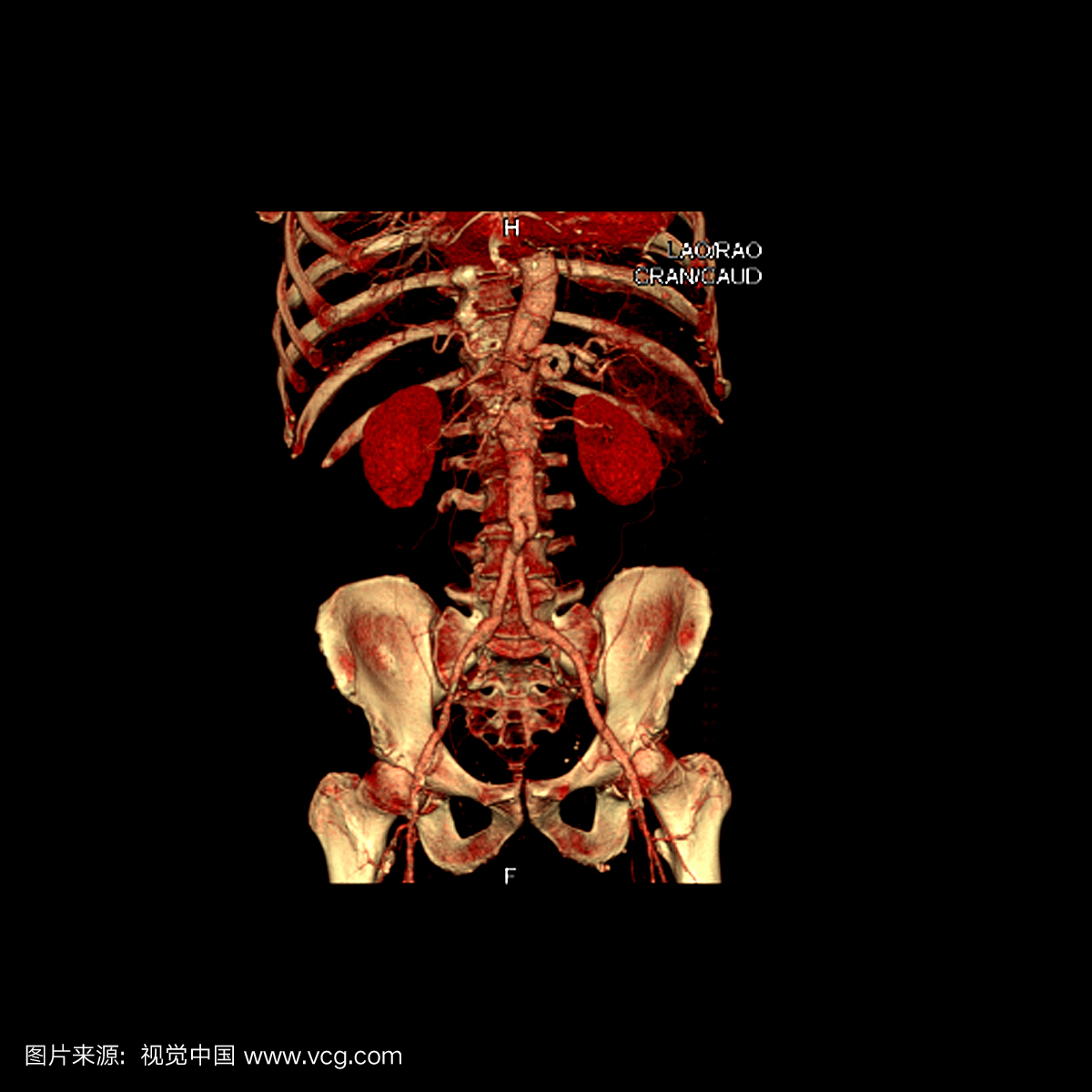 腹主动脉三维CT血管造影的正面视图显示腹主