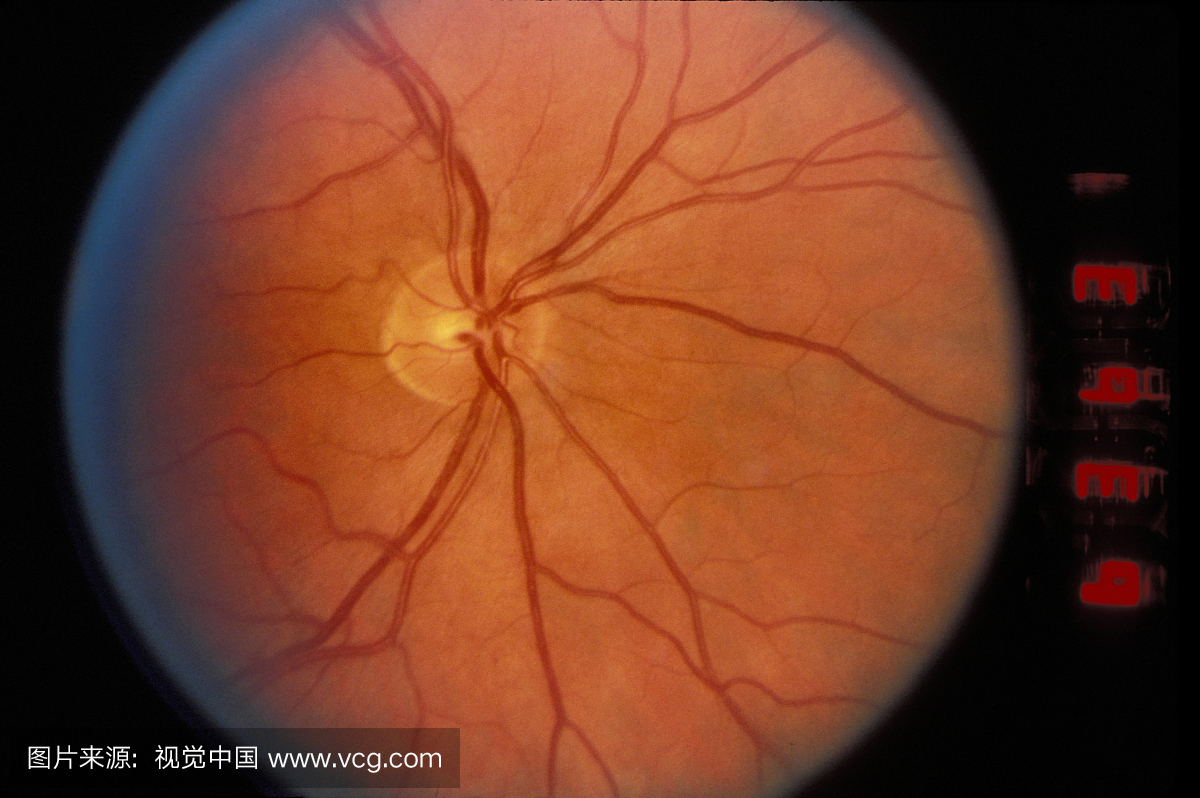 正常人类视网膜神经痛
