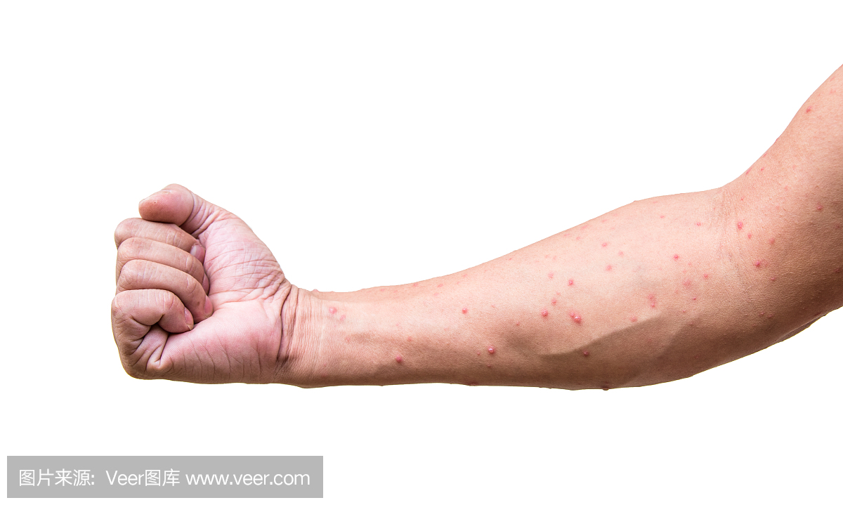 一名男子患有水痘水痘或水痘的手臂