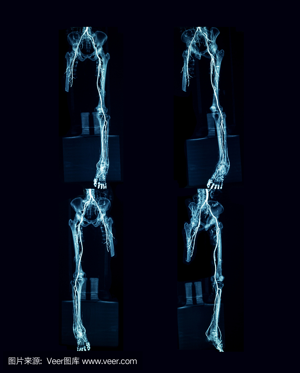 下肢肌电图(CTA)