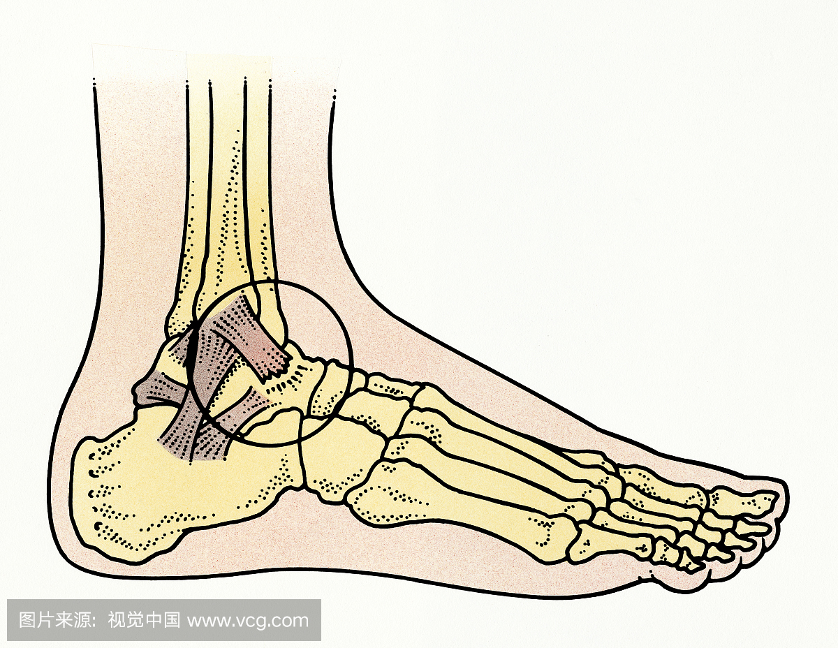 Illustration of child's ankle showing torn anterior