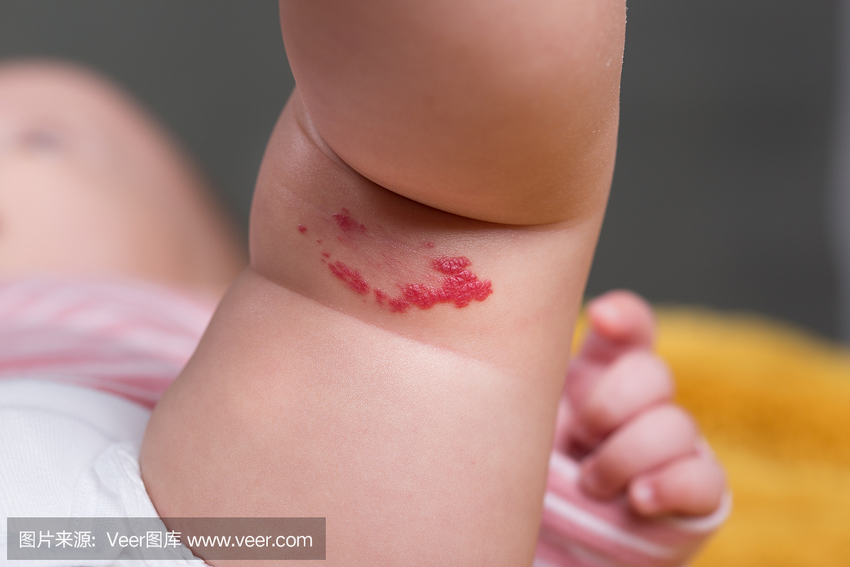婴儿腿上的毛细血管瘤红色胎记