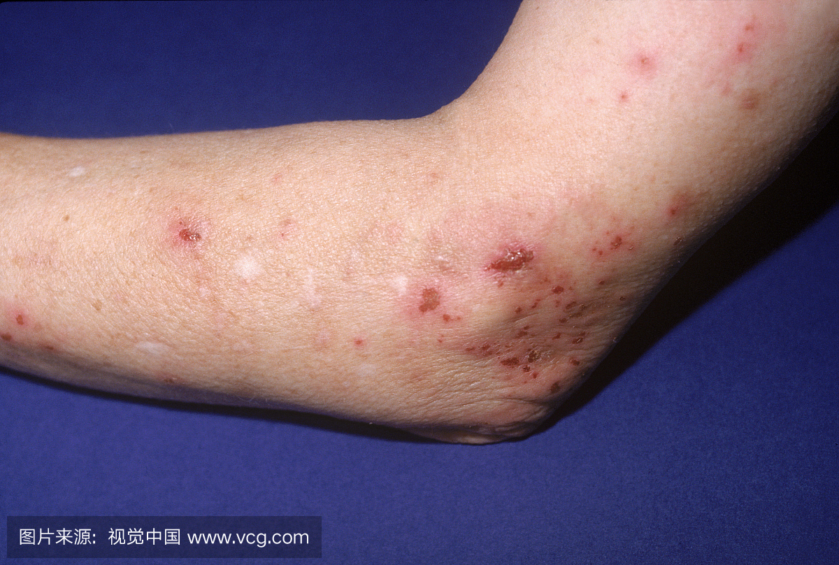 人造皮肤炎,也称为皮炎病毒,是造成病变责任一
