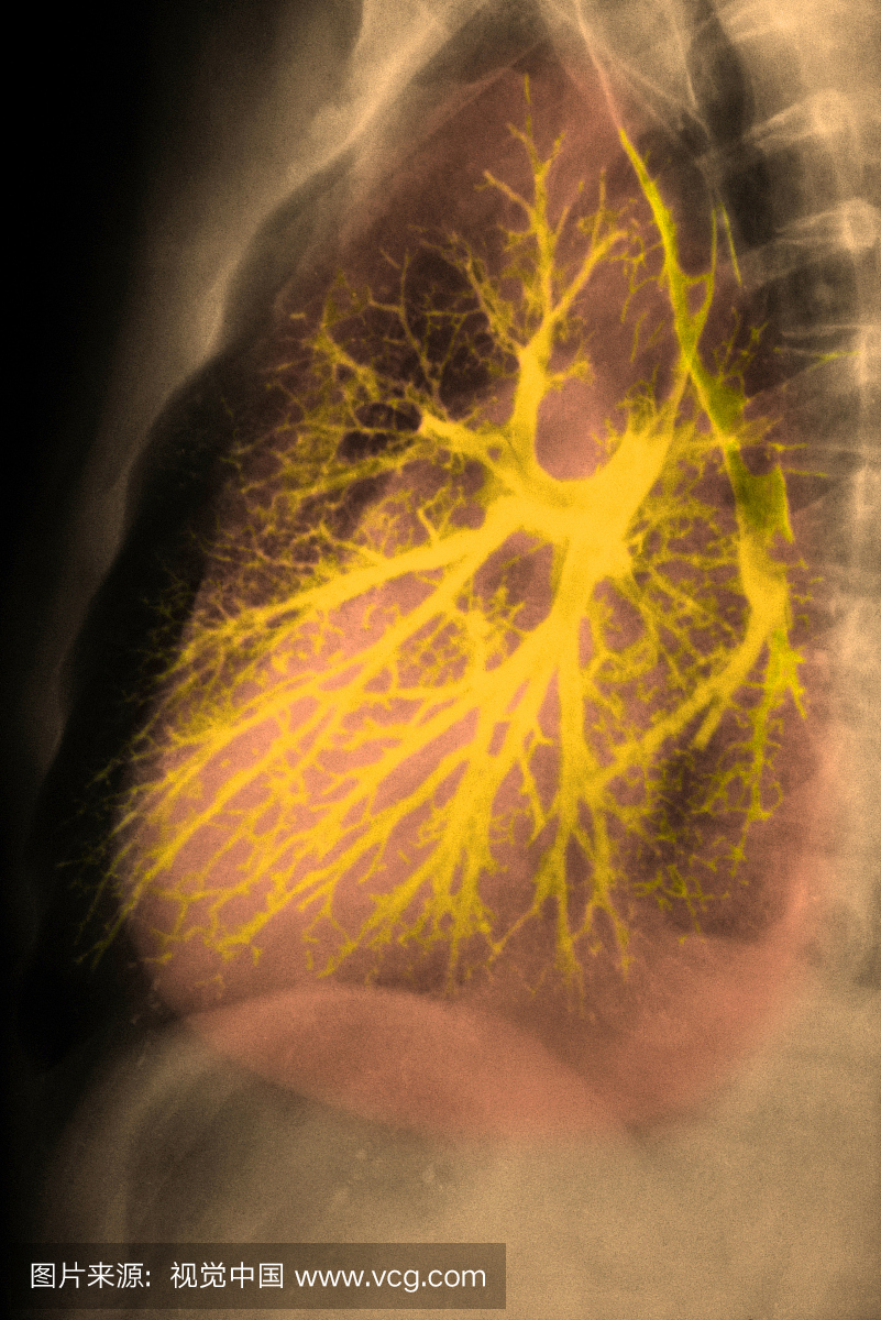 健康肺支气管图。支气管造影通过将无线电不透