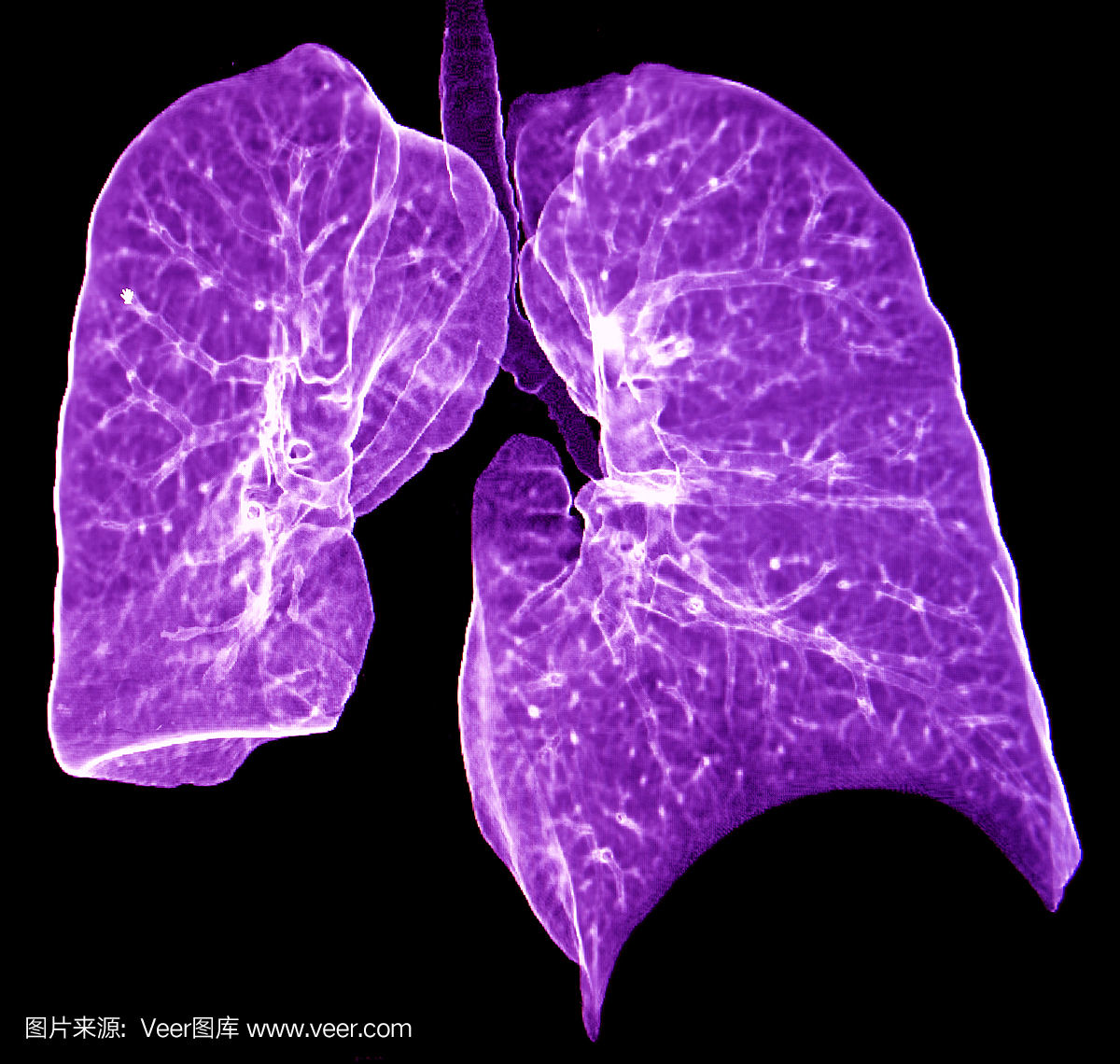 肺CT