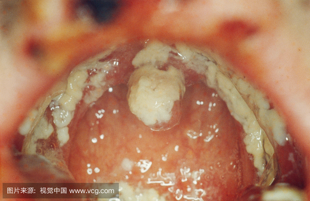 感染(念珠菌病)的舌头.引起局部炎症和不适的