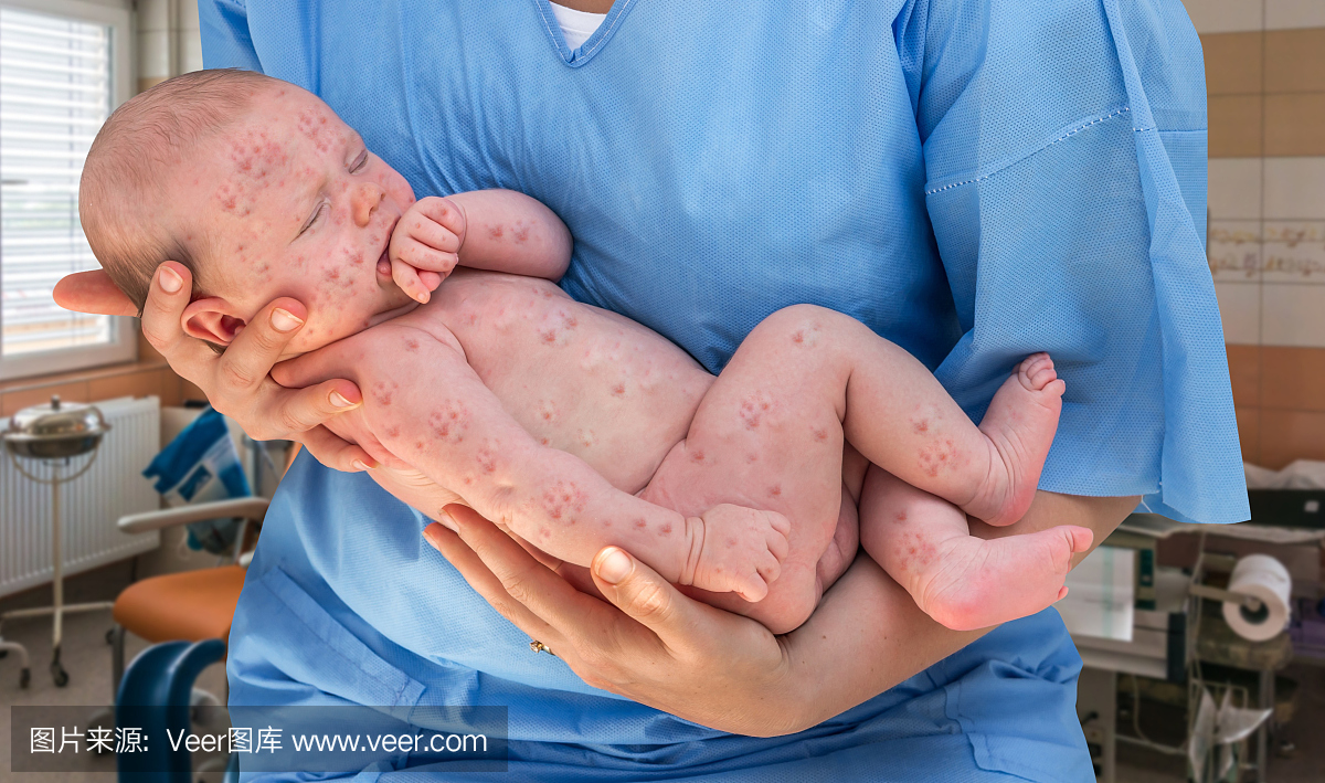 Newborn baby with chickenpox, measles or rub