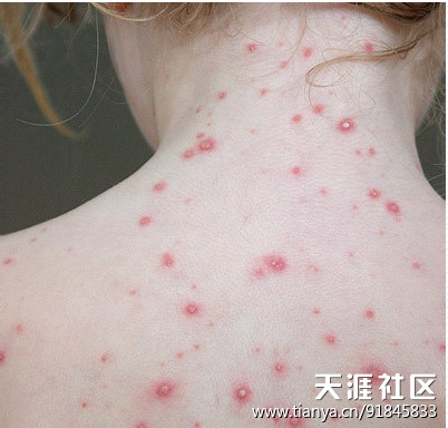 人得了猫癣怎么治啊_人得猫癣吃啥药_人得猫癣症状