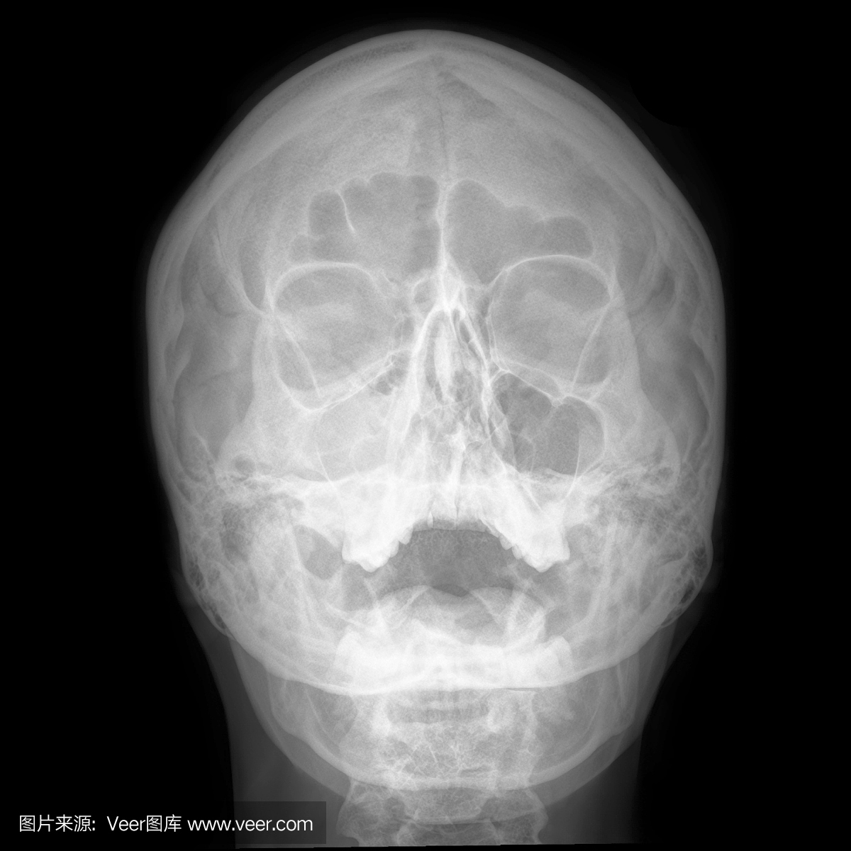 数字颅骨X线片显示鼻窦炎引起头痛